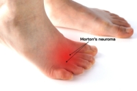 Morton’s Neuroma and Ball of Foot Pain