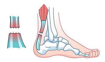 achiles rupture repair