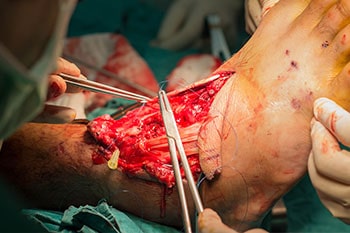 tendon repair reconstruction