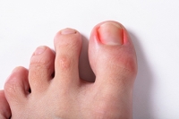 Ingrown Toenails May Become Infected if Not Treated Promptly