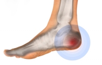 Heel Pain Causes and Possible Remedies