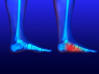 Tips for People with Flat Feet