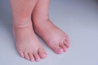 Swollen Feet During Pregnancy Is Normal
